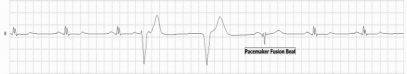 Fusion of paced and normal beat Rhythm Strip